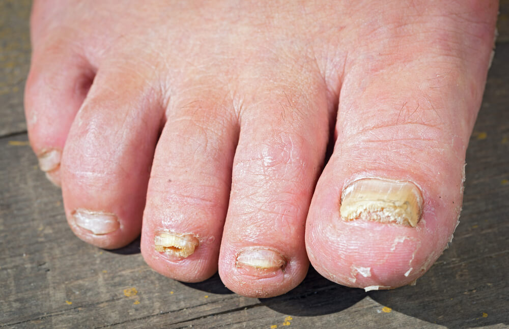 Toenail Fungus