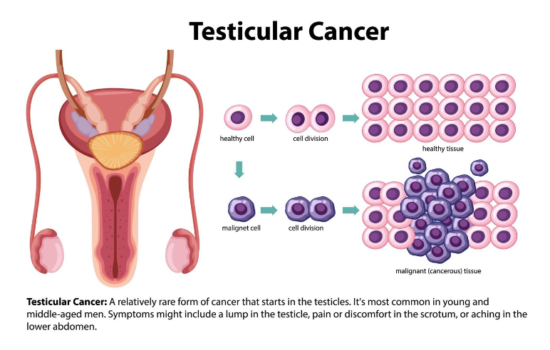Testicular Cancer: Understanding the Signs with Real Pictures