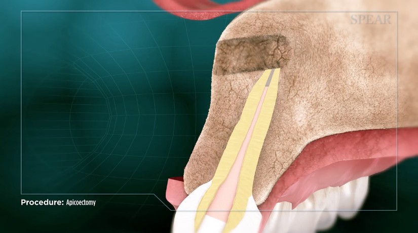 Does Meridian Endodontics Perform Apicoectomy?