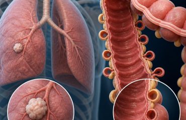 Difference Between Lung Nodule and Diverticulosis